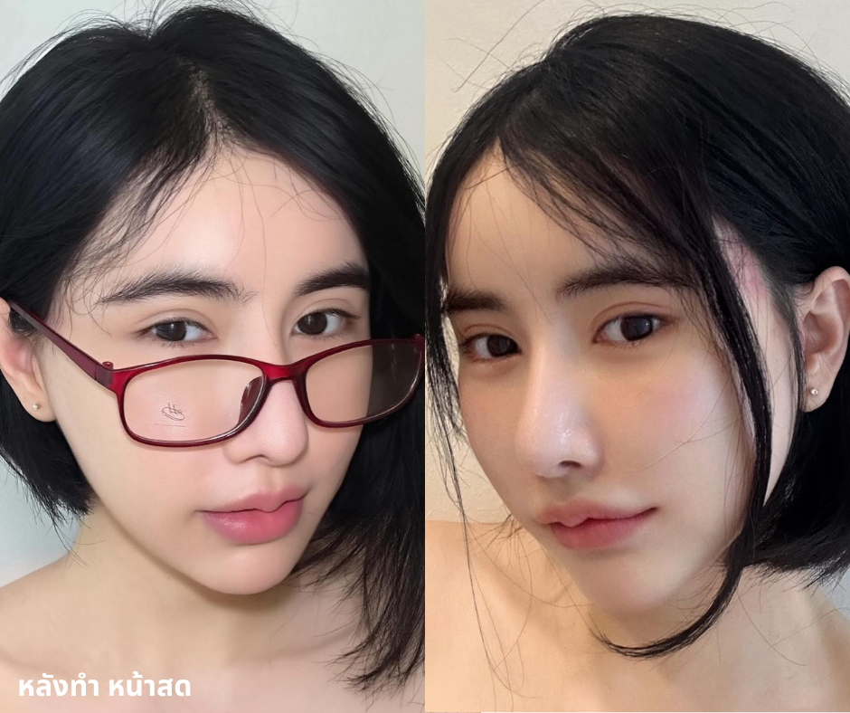 หลังดึงหน้าเกาหลี