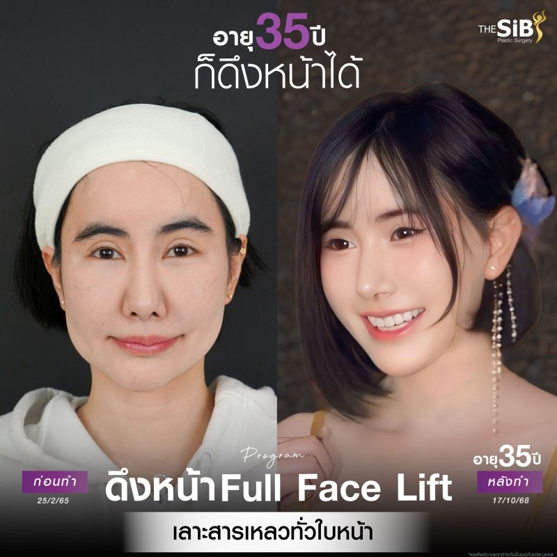 ดึงหน้าเกาหลี