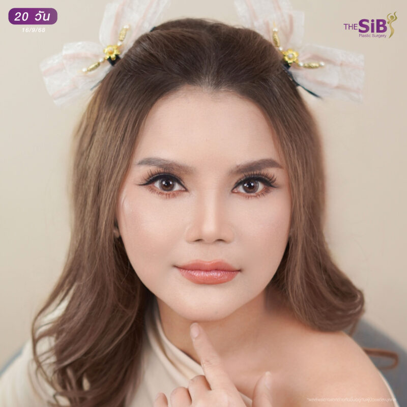 อัปเดตผลลัพธ์หลังดึงหน้า Full Facelift พี่จันทน์จวง 20 วัน