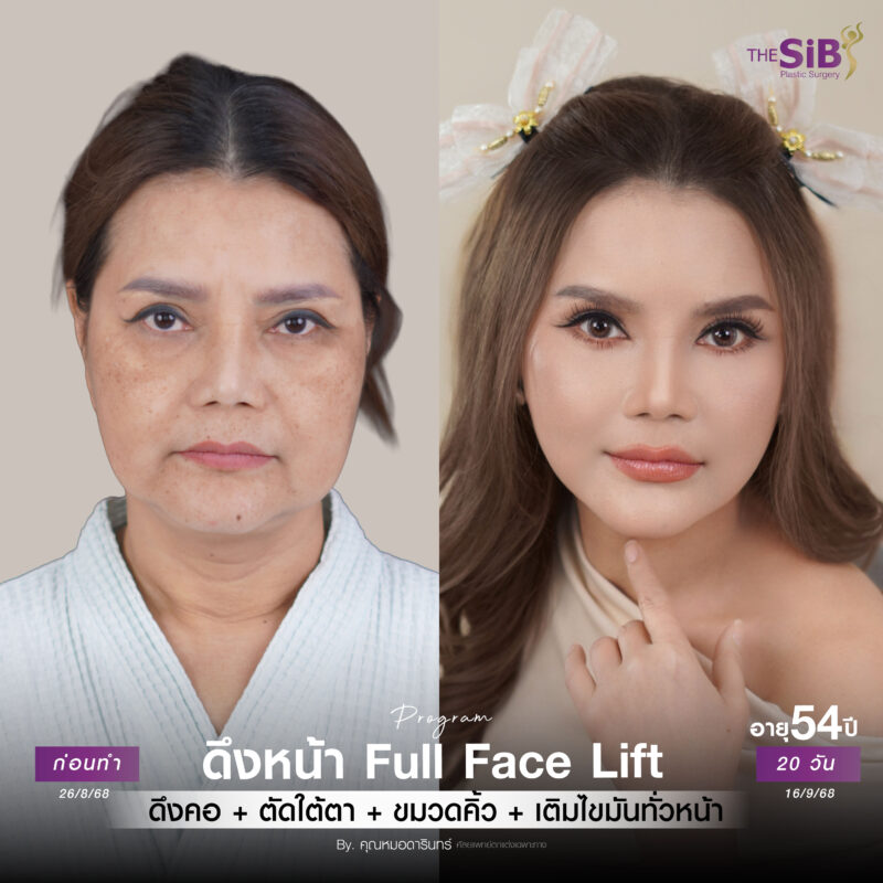 ผลลัพธ์ก่อนหลังดึงหน้า The SiB