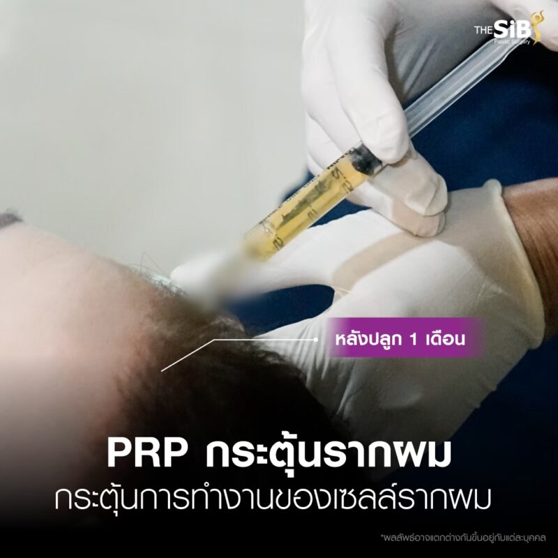 รีวิวปลูกผม LGBTQ