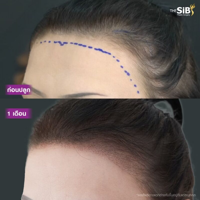 รีวิวปลูกผม LGBTQ