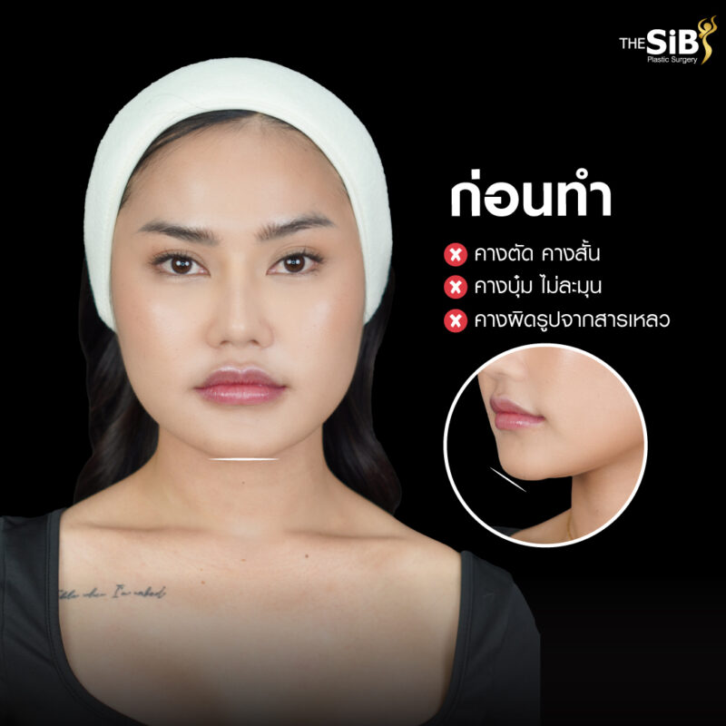 รีวิวทำคาง แก้ฟิลเลอร์