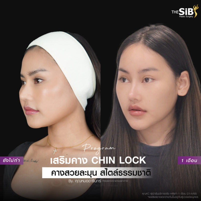 รีวิวทำคาง แก้ฟิลเลอร์