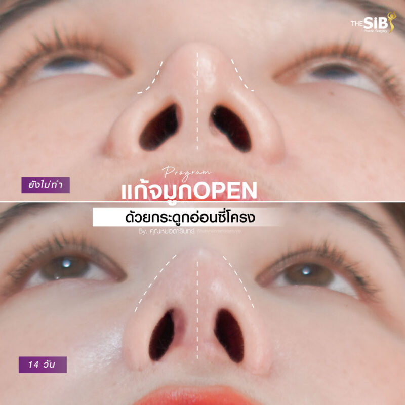 แก้จมูกปลายทะลุ