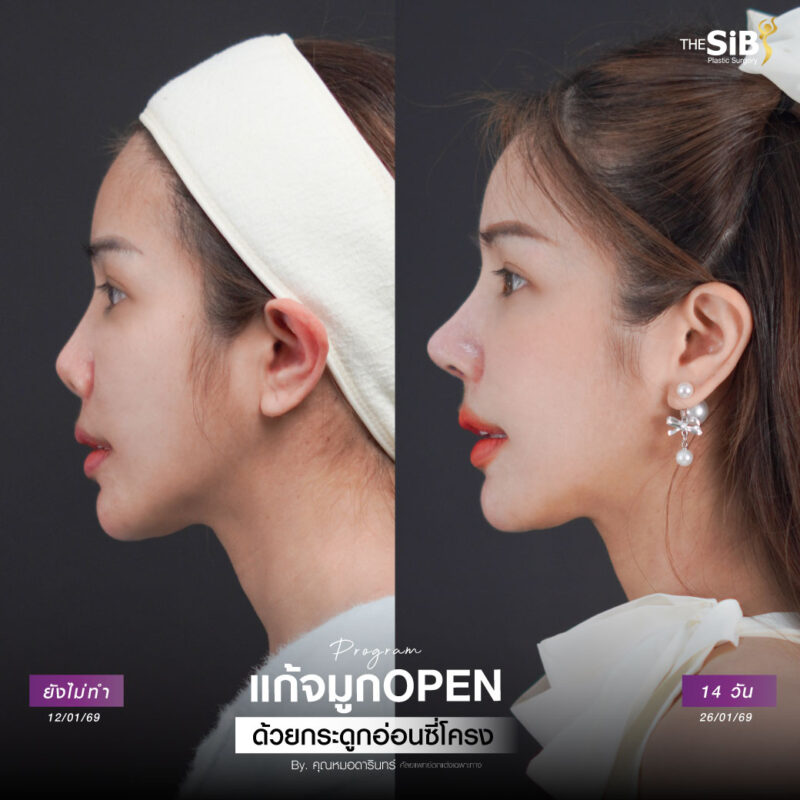 แก้จมูกปลายทะลุ