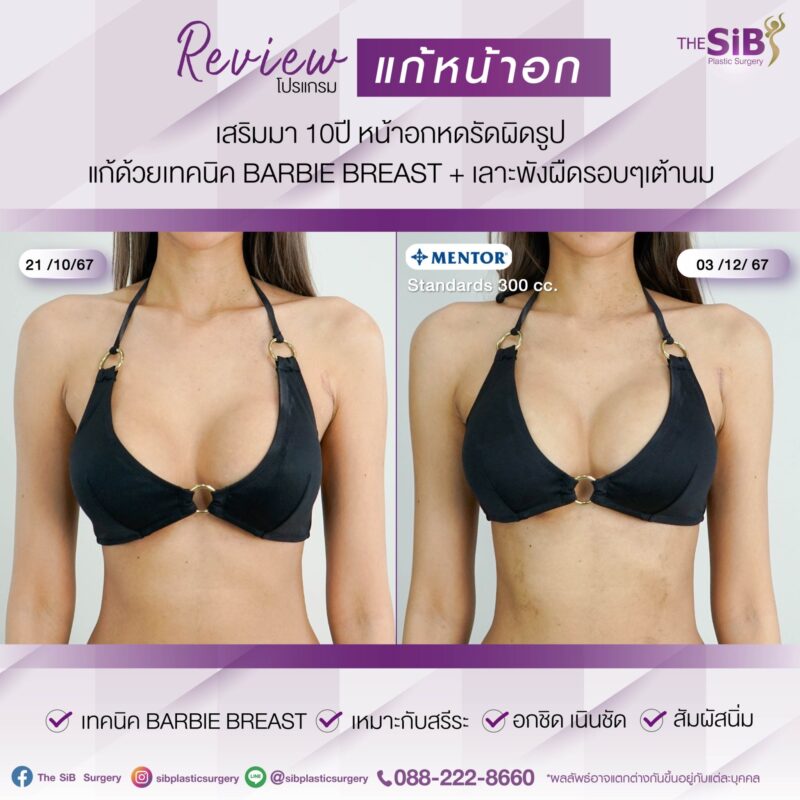 การแก้หน้าอกคืออะไร