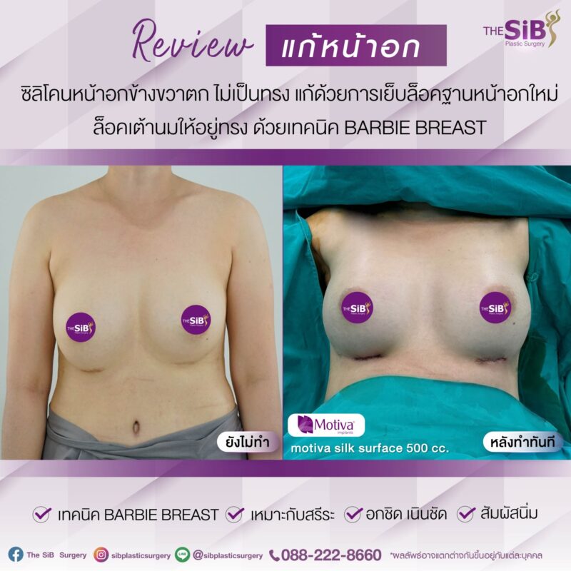 การแก้หน้าอกคืออะไร