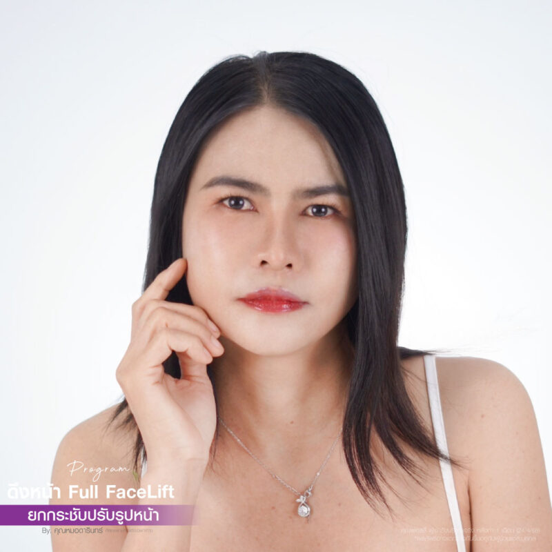 ดึงหน้าเจ็บไหม ดึงหน้าอายุ 50