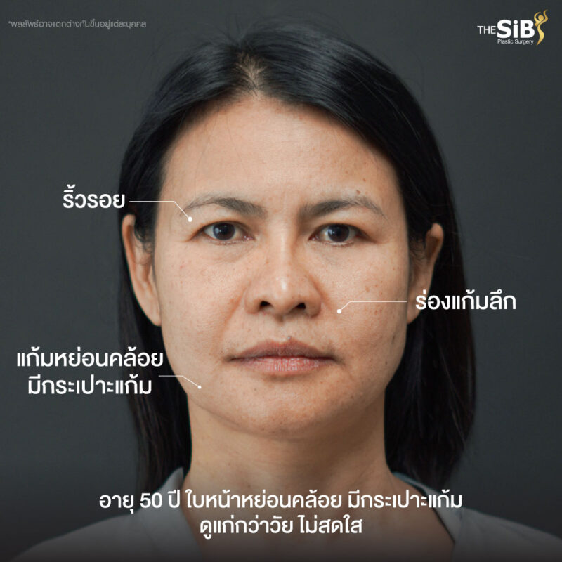 ดึงหน้าเจ็บไหม