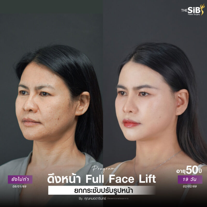 ดึงหน้าเจ็บไหม