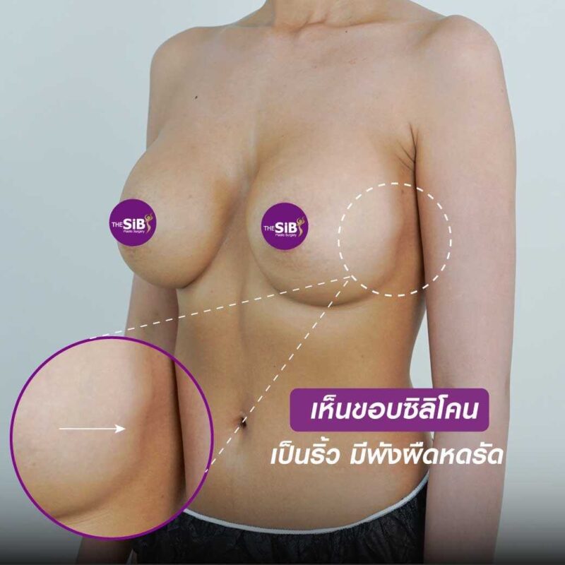 การแก้หน้าอกคืออะไร