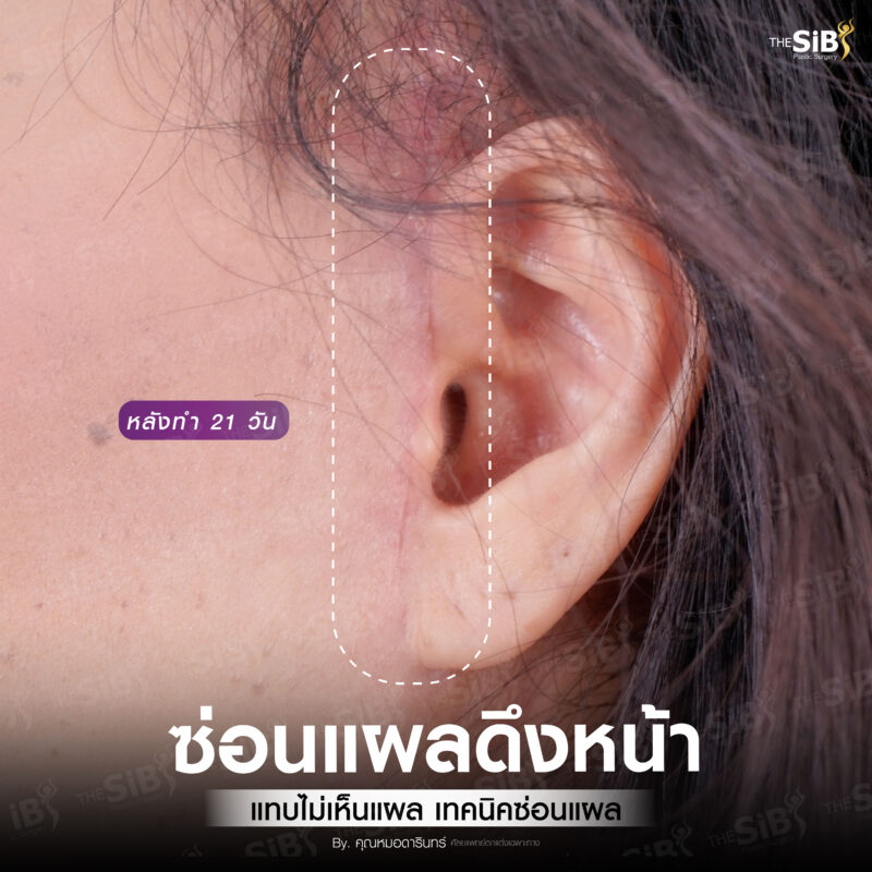 ดึงหน้า full facelift