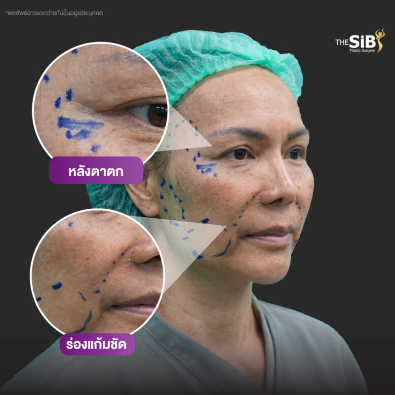 ดึงหน้า full facelift