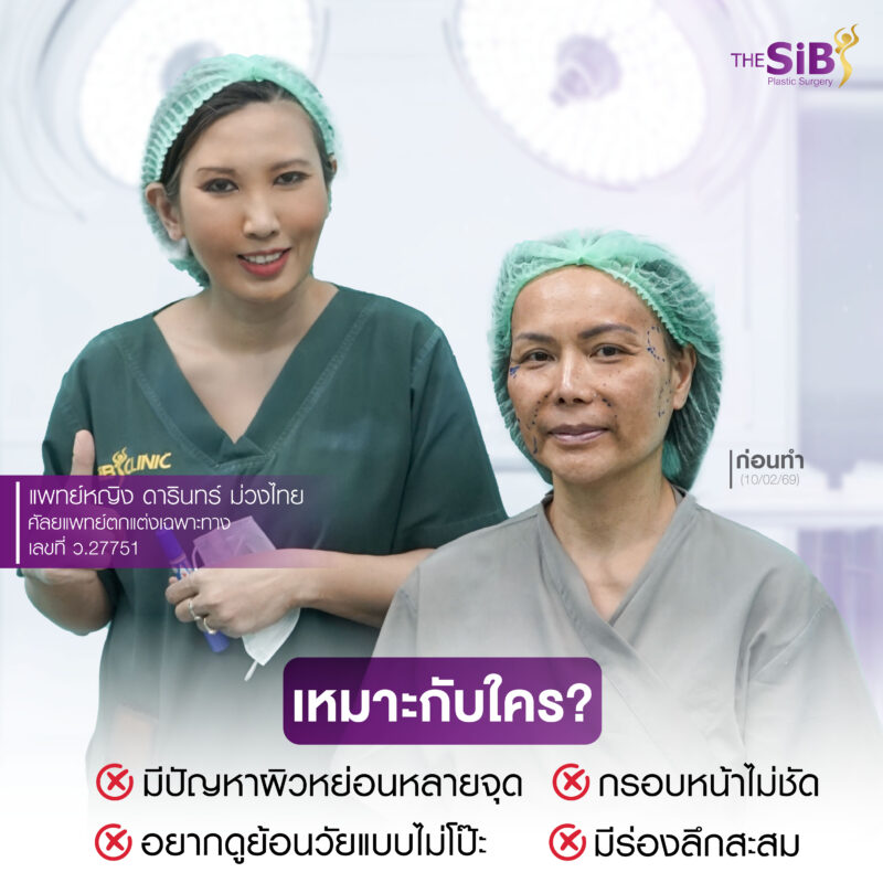 ดึงหน้า full facelift