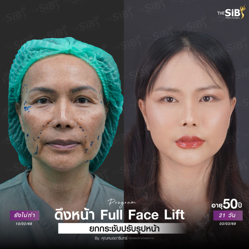 ดึงหน้า full facelift
