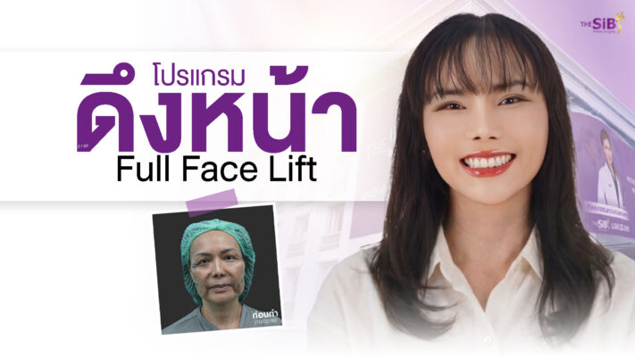 ดึงหน้า full facelift