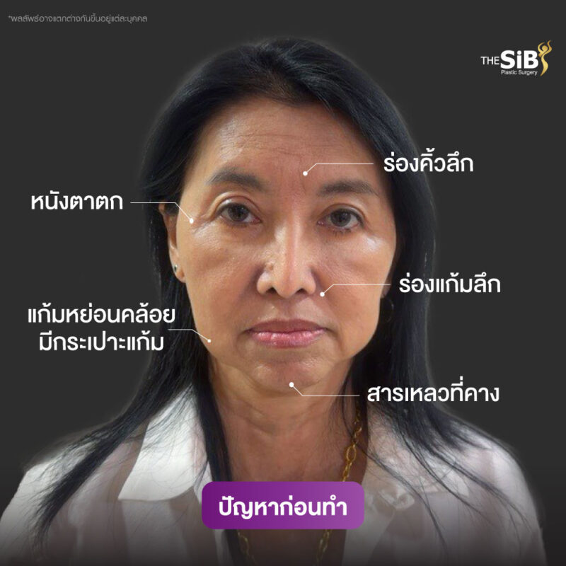 ดึงหน้าย้อนวัย-คุณสรญา