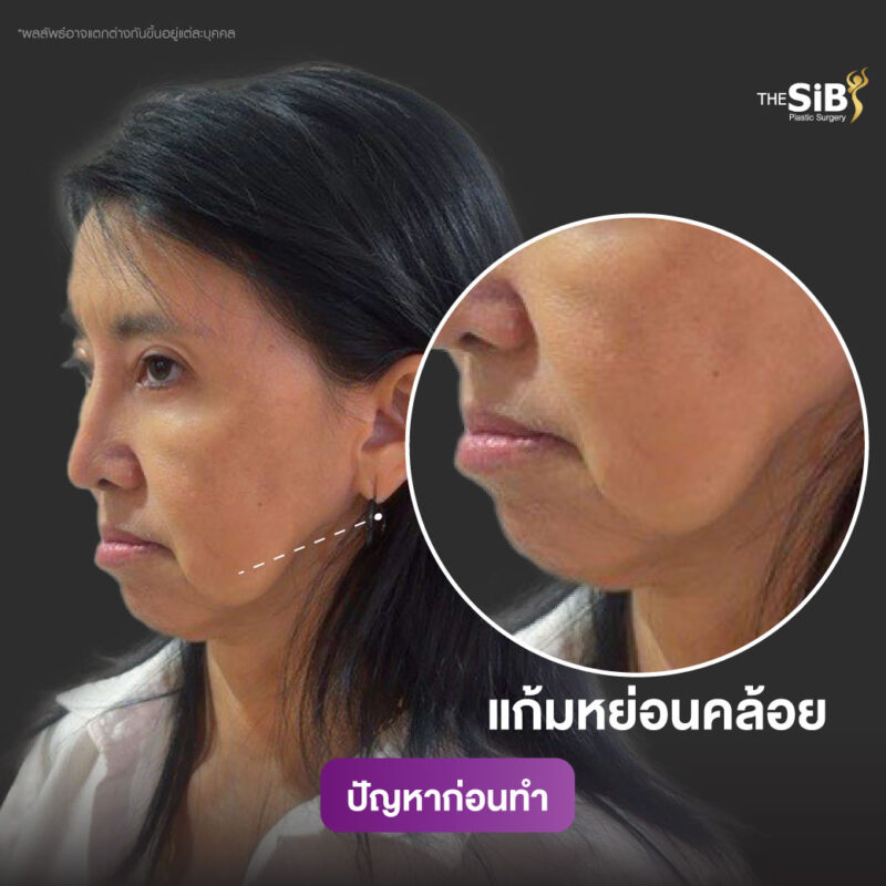 ดึงหน้าย้อนวัย-คุณสรญา