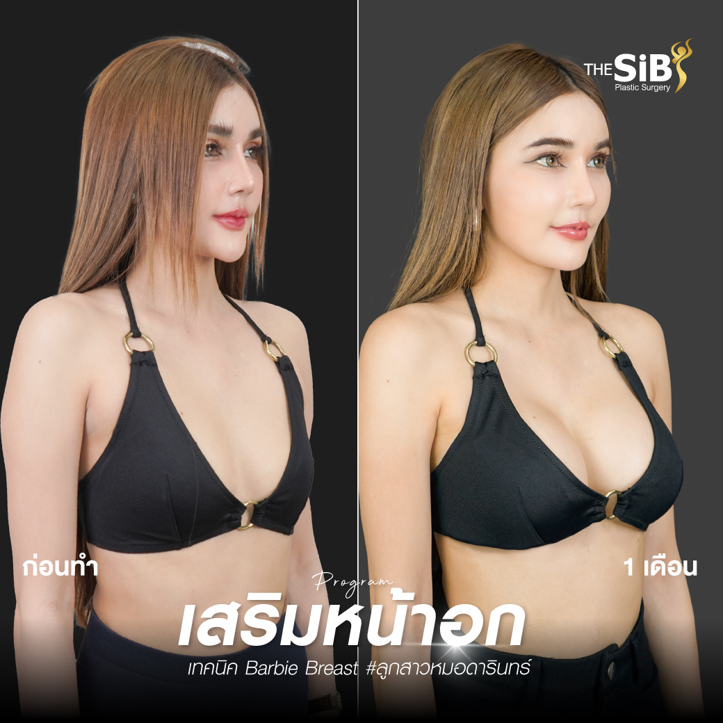รีวิวเสริมหน้าอก