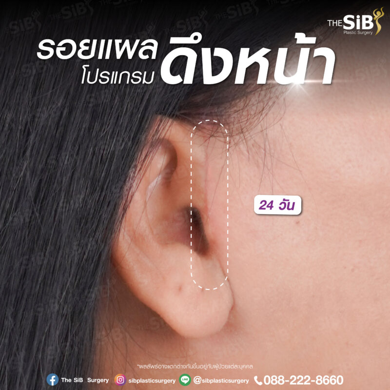 รีวิวดึงหน้า Full Facelift