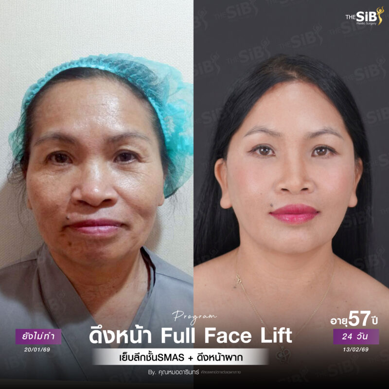 รีวิวดึงหน้า Full Facelift