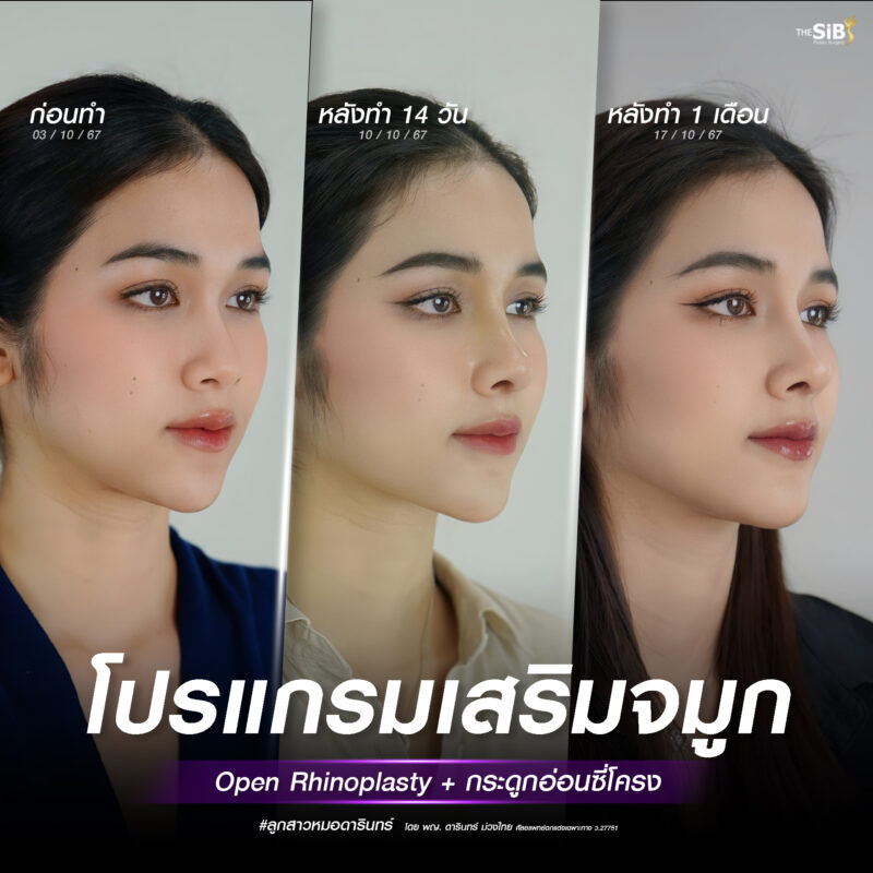 รีวิวเสริมจมูกโอเพ่น - คุณออม