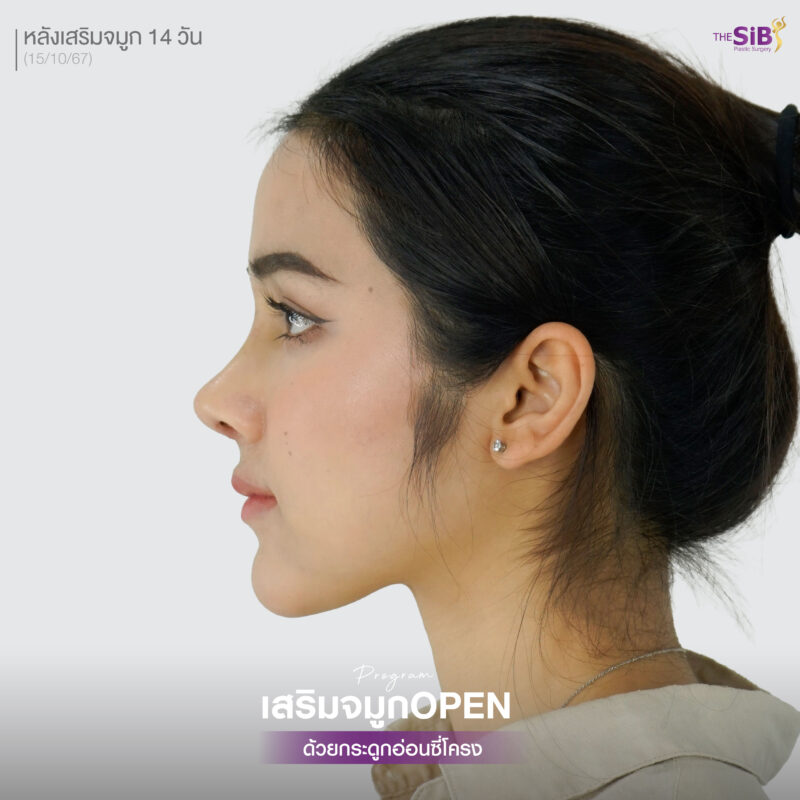 รีวิวเสริมจมูกโอเพ่น - คุณออม