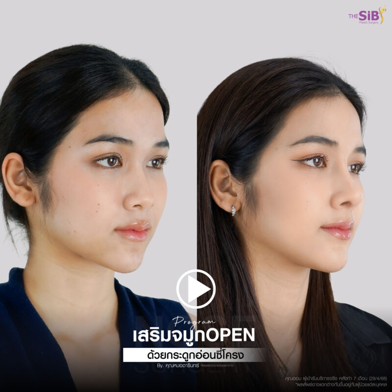 รีวิวเสริมจมูกโอเพ่น - คุณออม