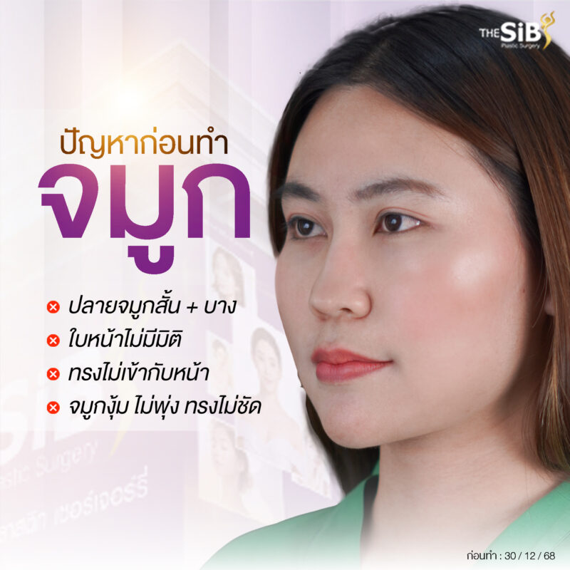 แก้จมูกซี่โครง