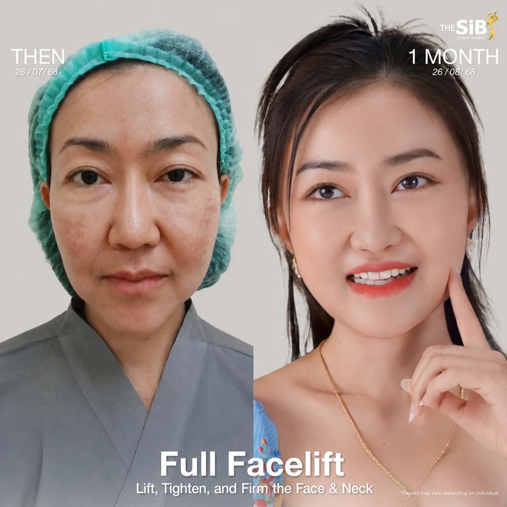 Comparison before and 1 month after facelift revision by Dr. Darin