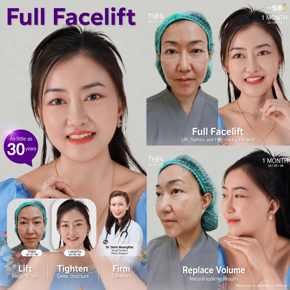 Confident results after a Deep SMAS Full Facelift revision