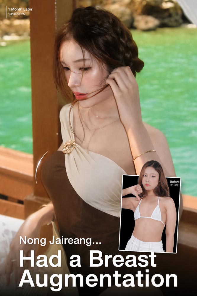 Comparison before and 1 month after breast augmentation of Nong Jai Roeng Tham Kimchi