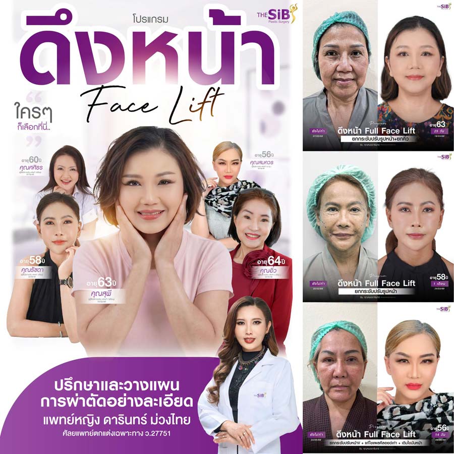 ภาพจำลองผลลัพธ์ Deep Plane Facelift