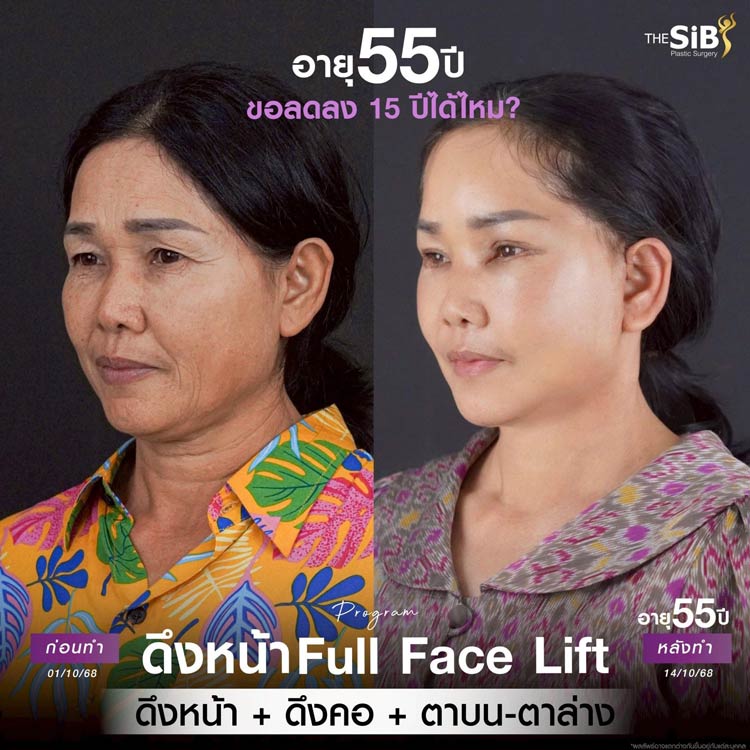 ผลลัพธ์ความอ่อนเยาว์จากการดึงคอและใบหน้า