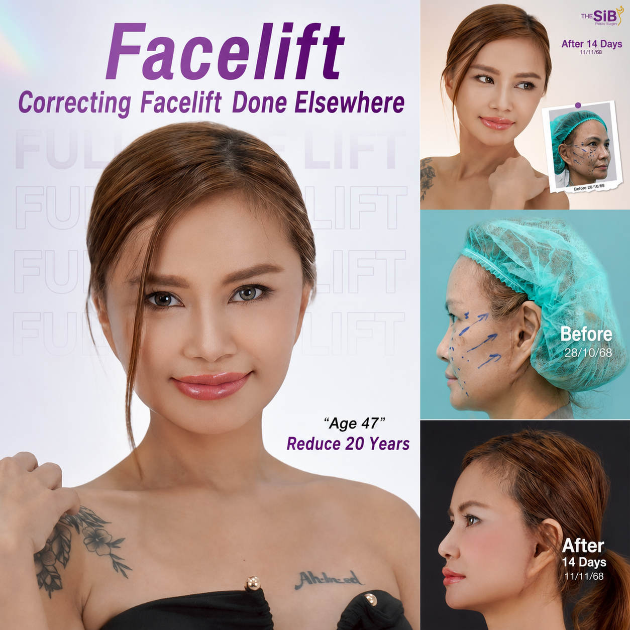 Summary of Full Facelift review, naturally restoring youthfulness