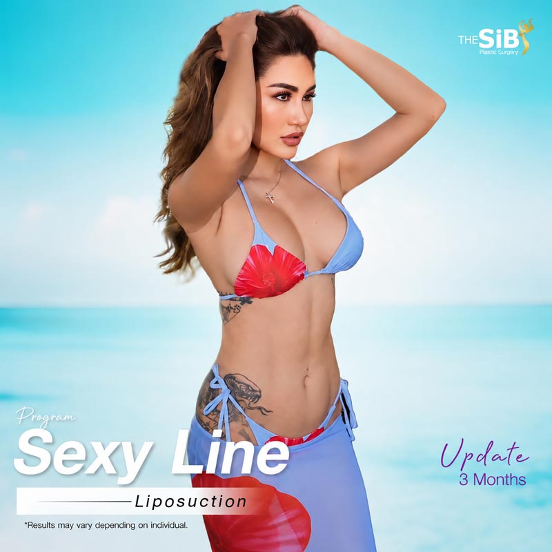 3-month update on Sexy Line and S-curve liposuction results, confidently wearing a two-piece