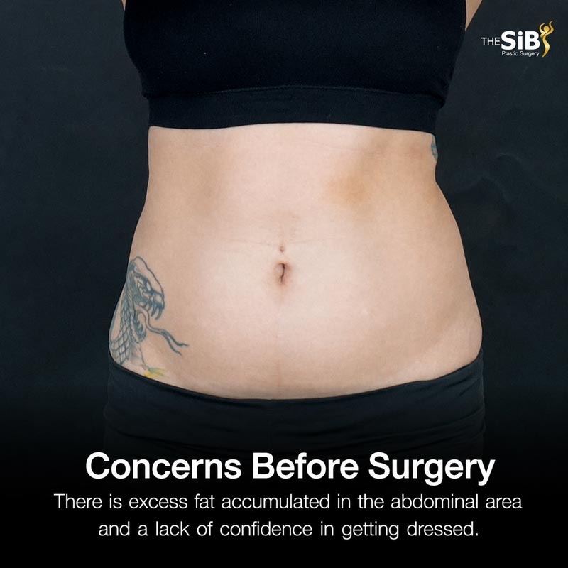 Pre-op abdominal liposuction issue: fat accumulation in the lower abdomen