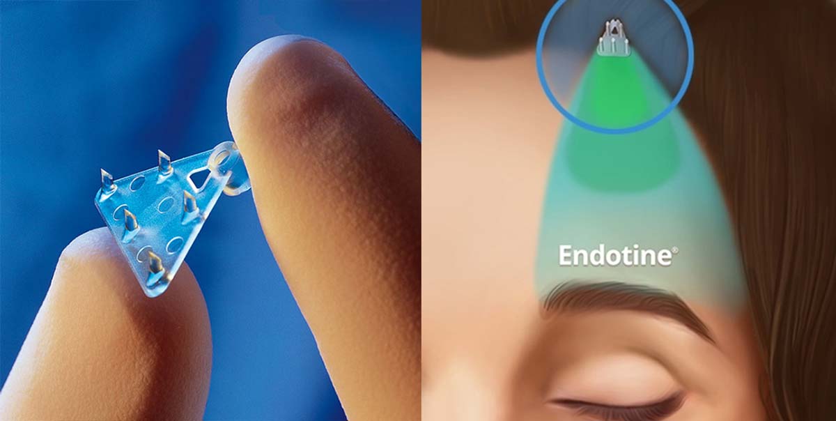 ลักษณะ Endotine Forehead และการใช้งาน