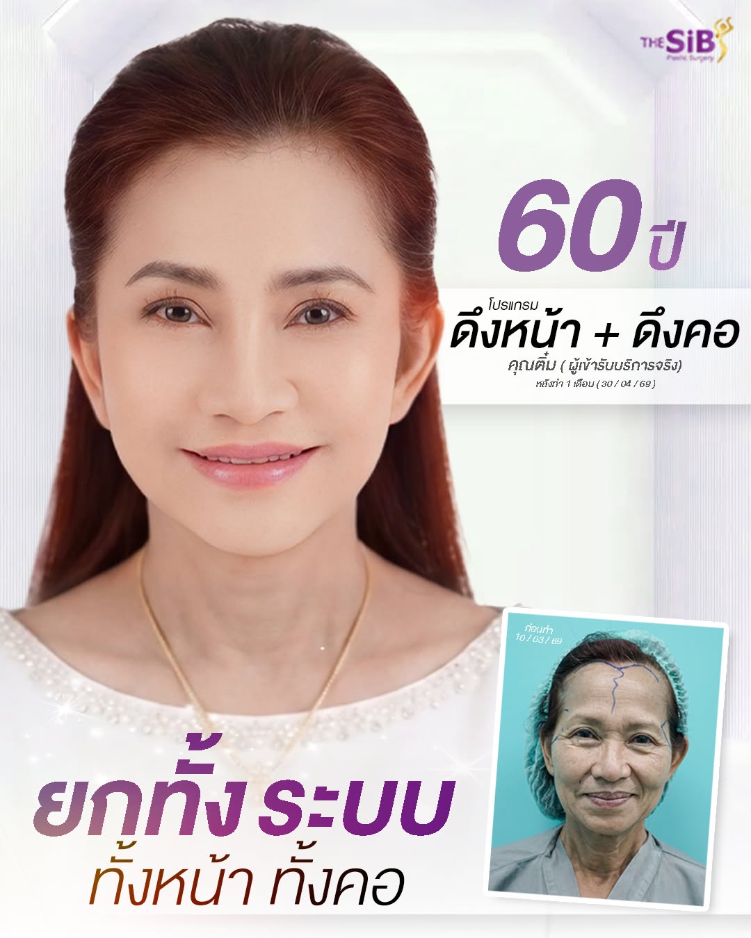 ความสวยงามและมั่นใจหลังการผ่าตัดดึงคอ