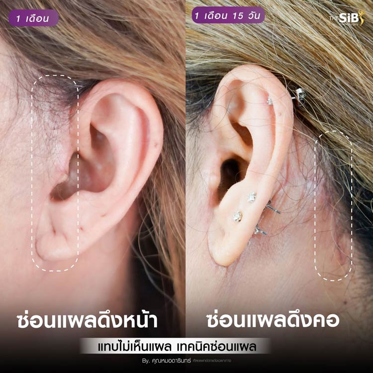 แผลดึงหน้า ดึงคอ