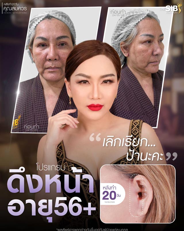ลูกค้าดึง Full Facelift ที่ The SiB Clinic