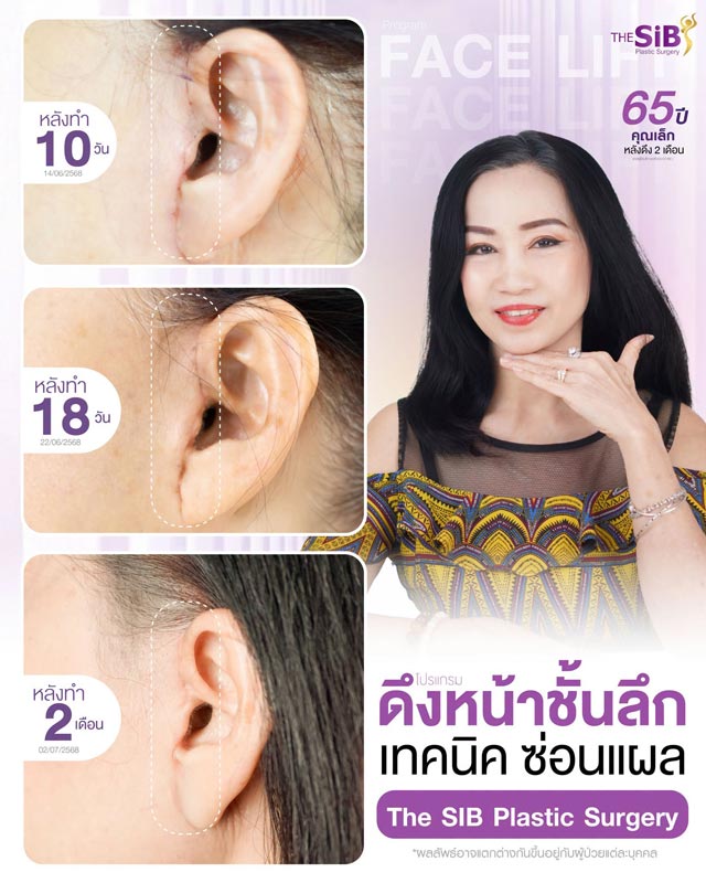 อินโฟกราฟิกเปรียบเทียบรอยแผลผ่าตัด Mini vs Full Facelift