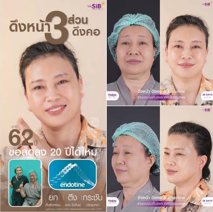 ความสุขและความมั่นใจหลังการยกกระชับใบหน้า