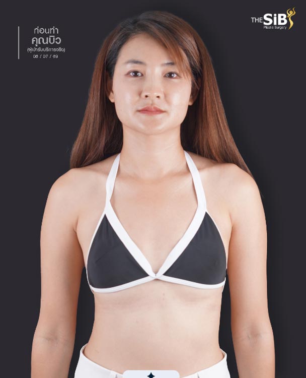 Choosing the right Mentor XtraGel silicone size to fit the body anatomy