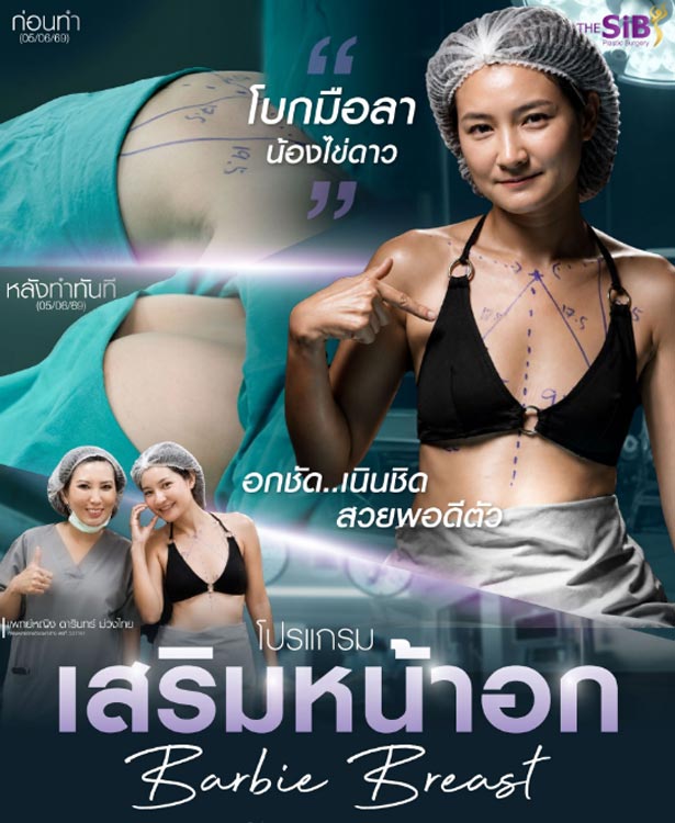 Summary of Bew's breast augmentation review using Mentor XtraGel 285cc