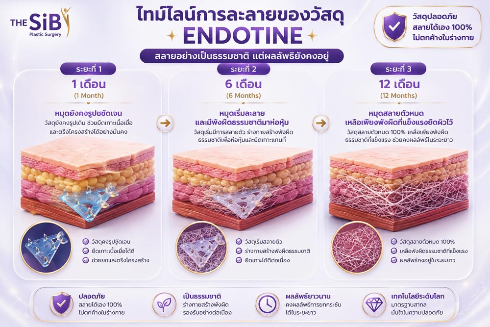 อินโฟกราฟิกไทม์ไลน์การละลายของ Endotine
