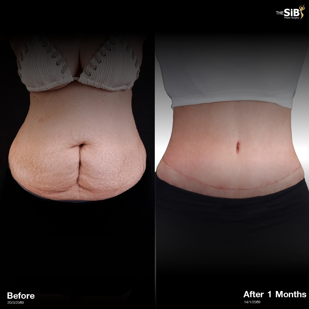 รีวิว Tummy Tuck ที่ The SiB