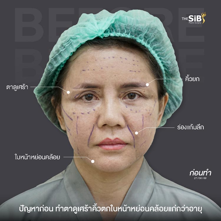 ปัญหาก่อนศัลยกรรม หนังตาตก ตาลึก จมูกแข็ง