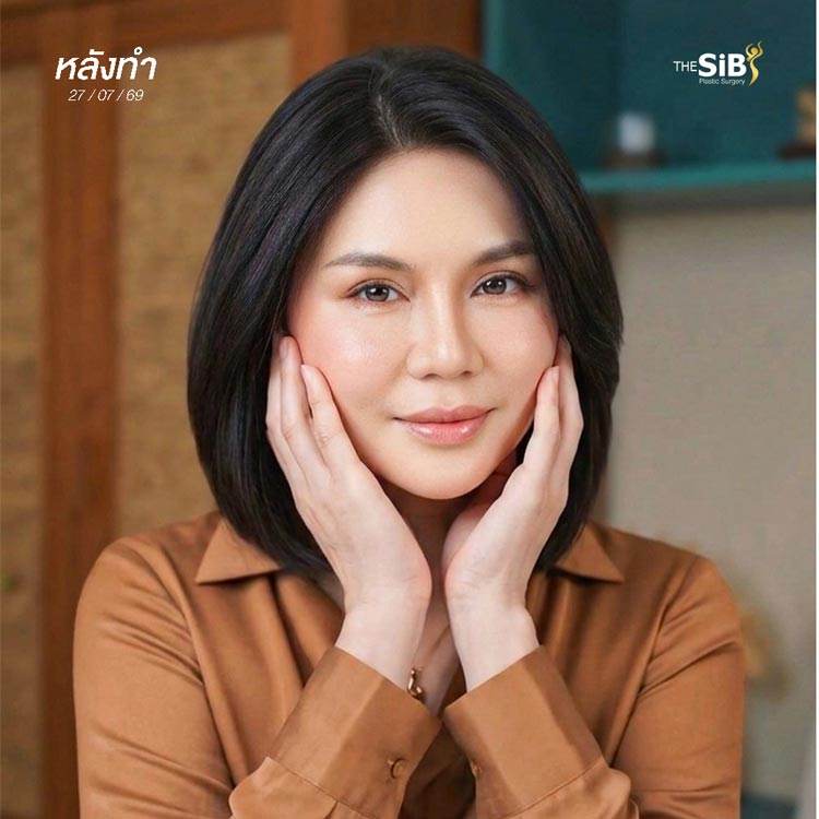 อัปเดตผลลัพธ์หลังผ่าตัด 23 วัน หน้าเด็กขึ้น ละมุนขึ้น
